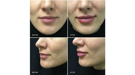 Juvederm Before And After - change comin