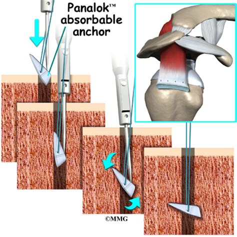 RunAwayImagination: Rotator cuff surgery