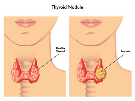 Thyroid Nodules Biopsy