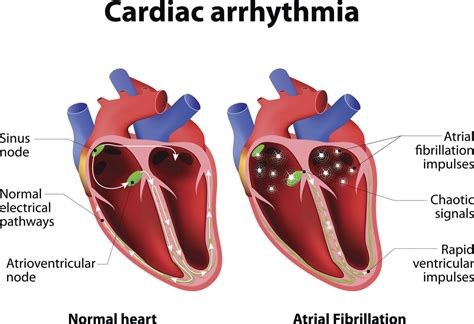 Afib | What is Afib | Afib Treatment | Afib Symptoms | Atrial Fibrillation Treatment