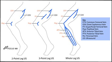 DVT Ultrasound Made Easy: Step-By-Step Guide in 2021 | Ultrasound ...