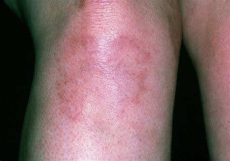 Systemic Lupus Erythematosus Rash On Woman's Leg Photograph by Dr P. Marazzi/science Photo Library