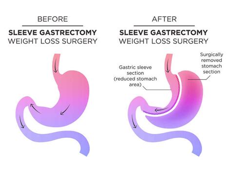 Gastric Sleeve | First Baptist Medical Center