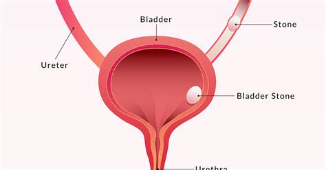 Bladder Stones | Symptoms Causes Prevention | Optimists Healthcare