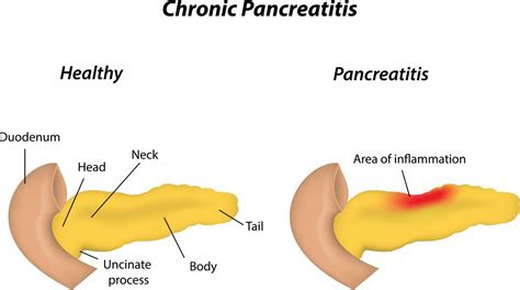 FCSEMS May Be an Effective First-Line Treatment for Chronic Pancreatitis-Associated BBSs ...