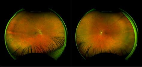 Operculated Retinal Hole