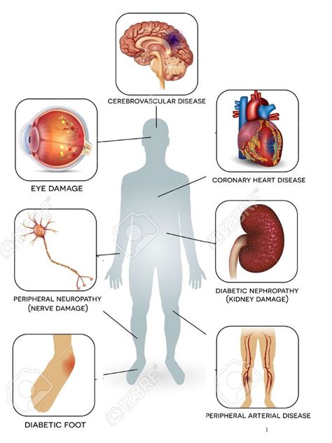 Diabetes mellitus : Sign & Symptoms, Causes, Diagnosis, Complication ...