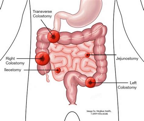 10 Best Clinics for Colostomy in South Africa [2023 Prices]