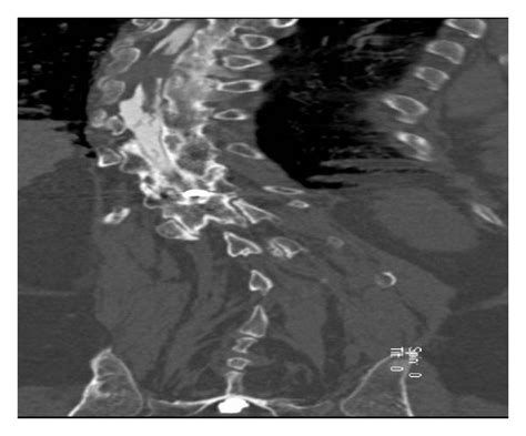 Axial and coronal reformatted CT myelogram images of thoracic spine... | Download Scientific Diagram