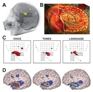 ECoG – OpenNeurosurgery.com