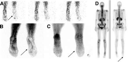 Complex Regional Pain Syndrome Diagnosed with Triple-Phase Bone Scanning