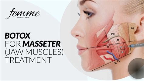 Masseter Botox - Reshape Your Face and Relieve Pain - Femme Aesthetics