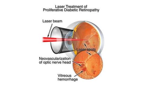 What is Diabetic Retinopathy? Best eye specialist in Delhi