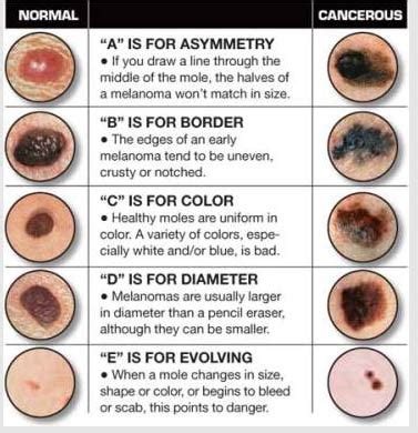 Skin Cancer Types Chart