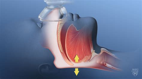 Obesity Hypoventilation Syndrome - Mayo Clinic | Obesity, Mayo clinic, Syndrome