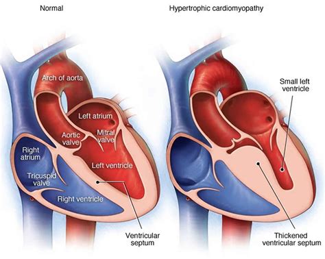 Left and right ventricular outflow tract obstruction causes, symptoms, diagnosis & treatment