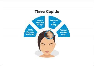 Tinea Capitis - Symptoms, Causes, Treatment & Prevention | RichFeel