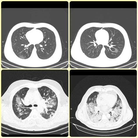 Chest computed tomography (CT) scans of different patterns of COVID-19... | Download Scientific ...