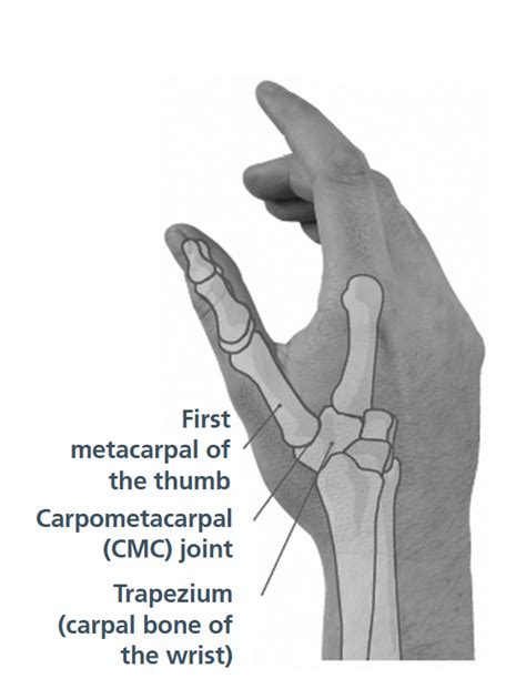 Osteoarthritis of the carpometacarpal thumb joint - South Tees Hospitals NHS Foundation Trust