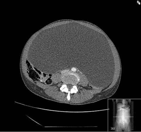 Giant mesenteric cyst: a rare cause of abdominal distension diagnosed with CT and managed with ...