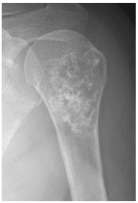 Cancers | Free Full-Text | Classification of Chondrosarcoma: From ...