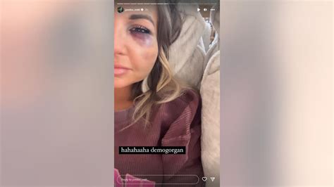 Morgan Wallen’s ex KT Smith shares facial injuries after she's involved ...