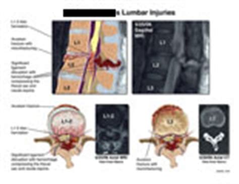 AMICUS Illustration of amicus,injury,avulsion,fracture,L1-2,lumbar,disruption,ligament ...