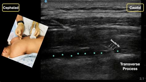 How to Perform an Erector Spinae Plane Block - ACEP Now