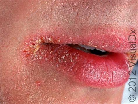 Angular Cheilitis Or Cold Sore