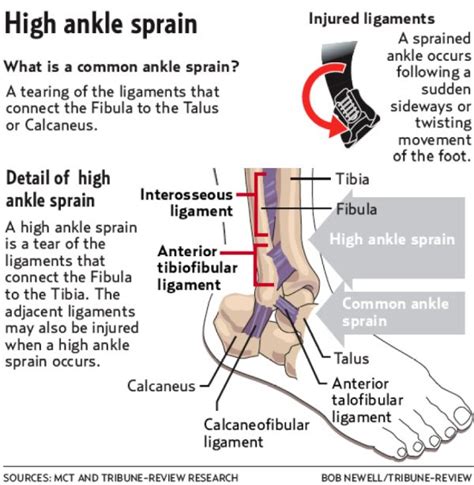 The Sidney Crosby Show: High Ankle Sprains Explained