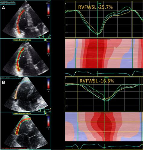 Right ventricular free wall strain analysis showing a normal RVFWSL in ...