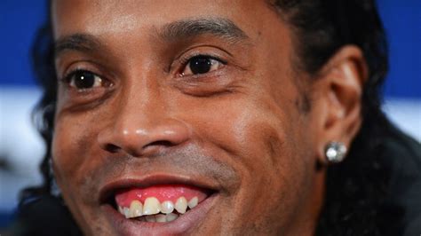 Así fue la operación dental a la que se sometió Ronaldinho