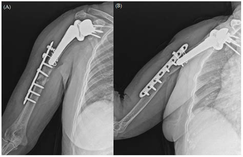 The Treatment of Periprosthetic Fracture Revision of the Humerus with “Bamboo Support ...