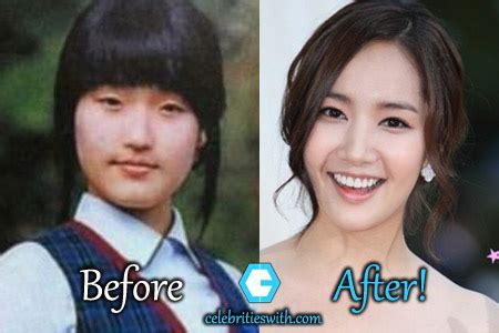 Park Min Young Plastic Surgery: Eyelid, Nose Job, Before After Pics ...