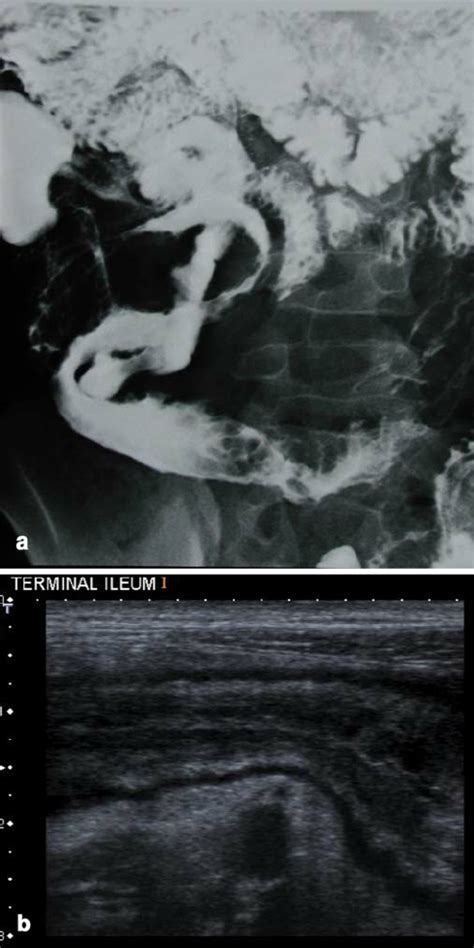 A child with Crohn disease. a Coned view of the terminal ileum showing ...