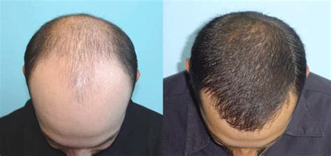 Hair Transplant Treatment: Hair Transplant 1000 Grafts Cost in Karachi