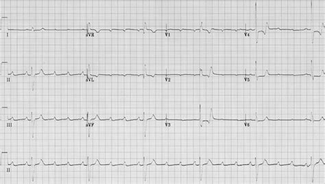 Av Block Ekg