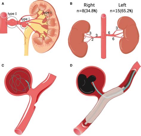 Frontiers | Eighteen cases of renal aneurysms: Clinical retrospective ...