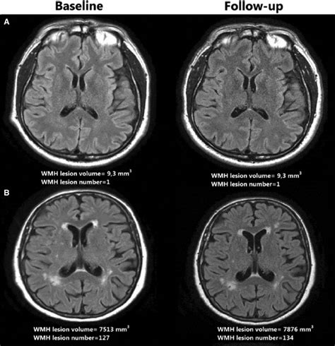 Association of White Matter Hyperintensities and Cardiovascular Disease | Circulation ...