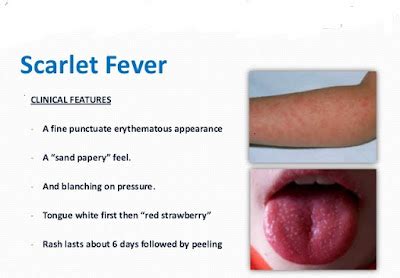 Pediatrics Notes: Clinical Features of Scarlet Fever