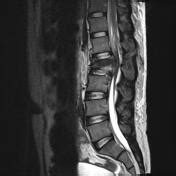 Cauda equina syndrome | Radiology Reference Article | Radiopaedia.org