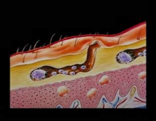 SCABIES: Types, Causes, Symptoms, Diagnosis and Treatment