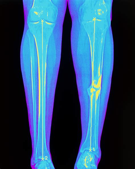 Coloured X-ray Of Fractured Shin Bone (tibia) Photograph by Mehau Kulyk