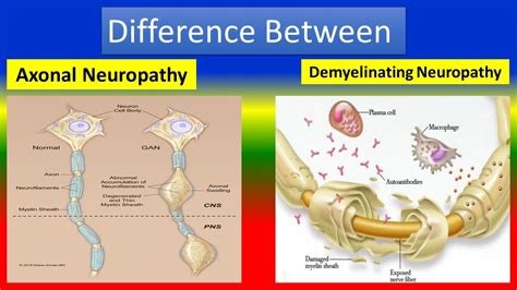 Different between Axonal Neuropathy and Demyelinating Neuropathy - YouTube