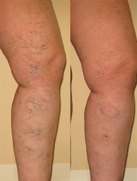 Varicose Vein Makeup For Legs | Saubhaya Makeup