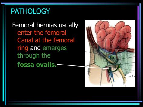 PPT - FEMORAL HERNIA & SLIDING HERNIA PowerPoint Presentation - ID:9423392