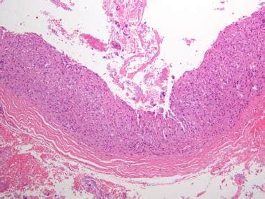 Trichilemmal Cyst (Pilar Cyst) Workup: Imaging Studies, Procedures, Histologic Findings