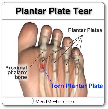 What is a Plantar Plate Tear? - Plantar Health