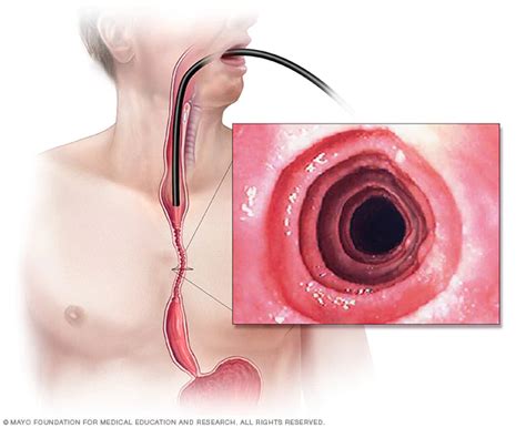 Eosinophilic esophagitis - Symptoms and causes - Mayo Clinic ...