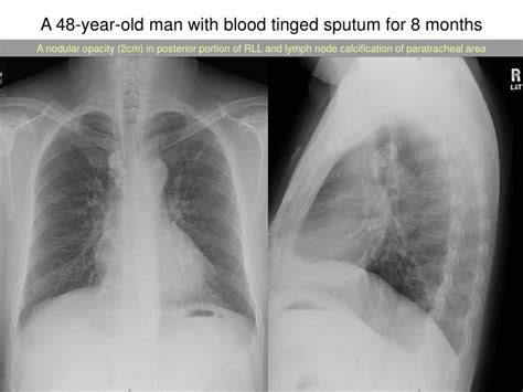 PPT - A 48-year-old man with blood tinged sputum for 8 months PowerPoint Presentation - ID:5026079